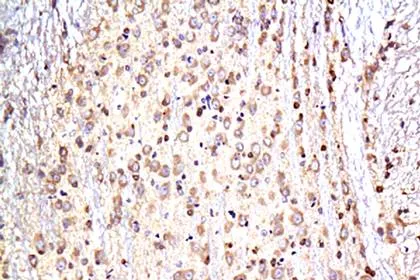 神经退行性疾病Neurodegeneration神经科学研究示意图