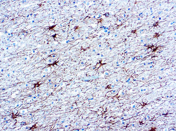 GLIAL FIBRILLARY ACIDIC PROTEIN (GFAP)