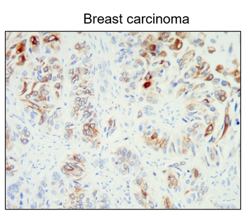 Breast Cancer Biomarkers Antibody Panel