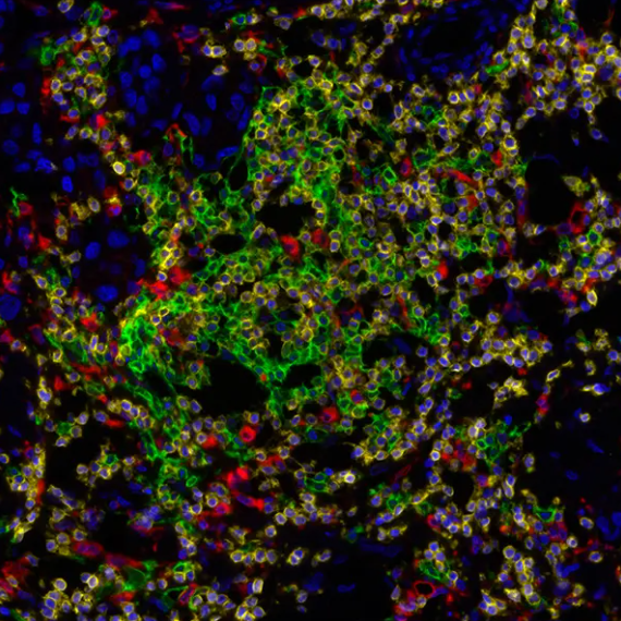 Immune Localization PathPlex Panel (CD3E, CD68, CD20)